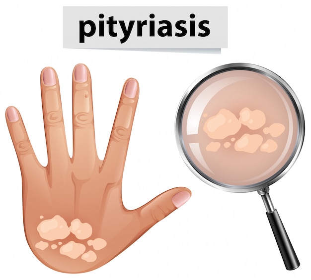 Vecteur un vecteur de pityriasis sur la peau humaine