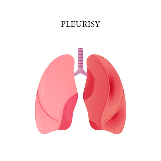 Vecteur de pleurésie, illustration de la maladie de pleurésie, conception de vecteur pour le médical