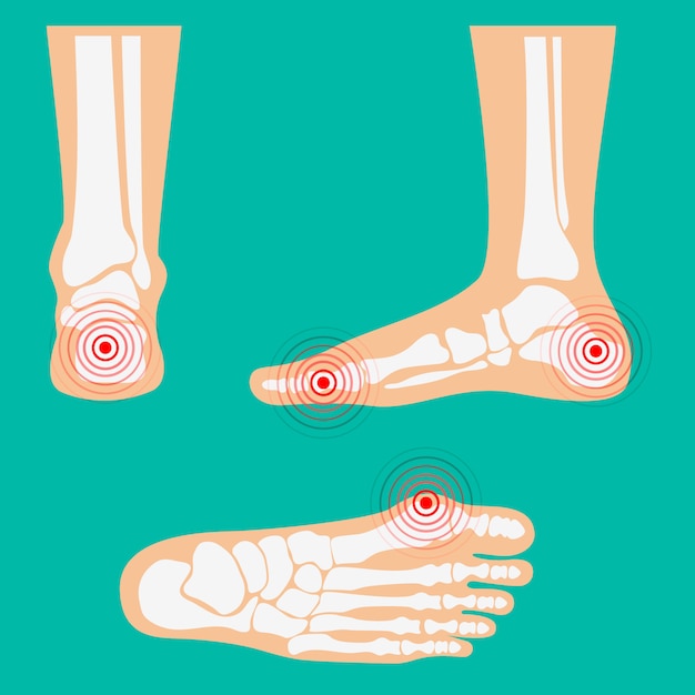 Zones De Douleur Aux Jambes Humaines.