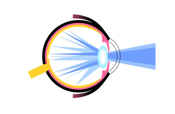 Vector cataract eye disease