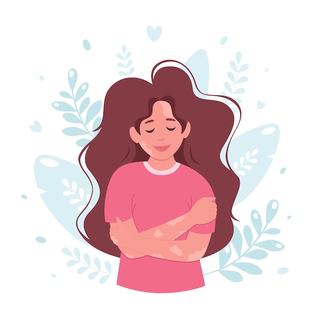 Người phụ nữ bị bạch biến Ngày bạch biến thế giới Yêu bản thân Chăm sóc bản thân Cơ thể tích cực Hình ảnh minh họa vector