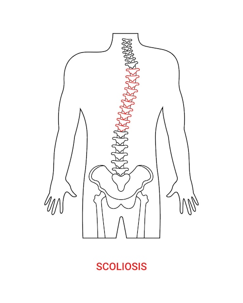 Scoliosis disease medical design with line style