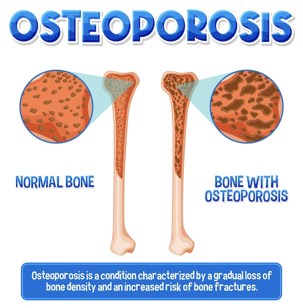 Vector gratuito afiche informativo de osteoporosis ósea humana