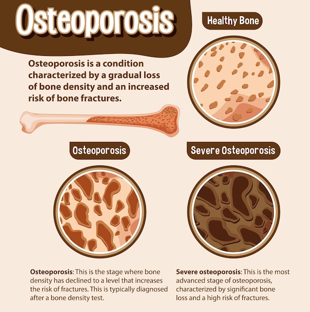 Vector gratuito afiche informativo de osteoporosis ósea humana