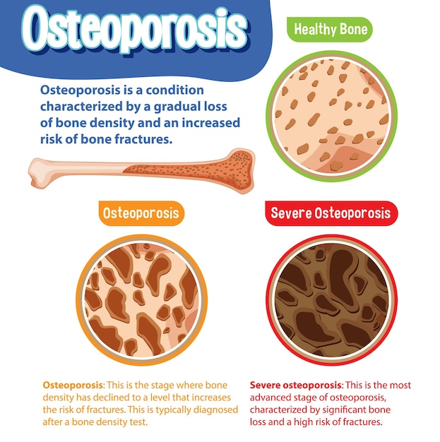 Vector gratuito afiche informativo de osteoporosis ósea humana