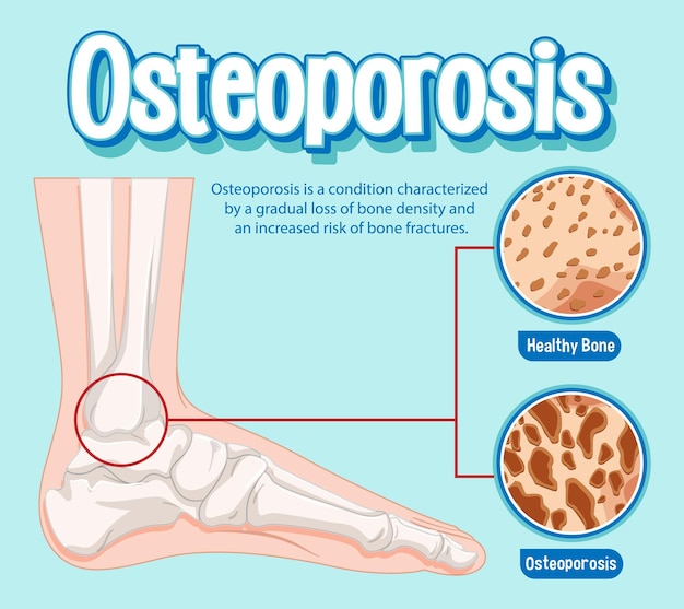 Afiche informativo de osteoporosis ósea humana