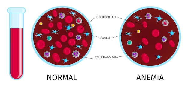 Análisis de sangre con infografía de anemia.