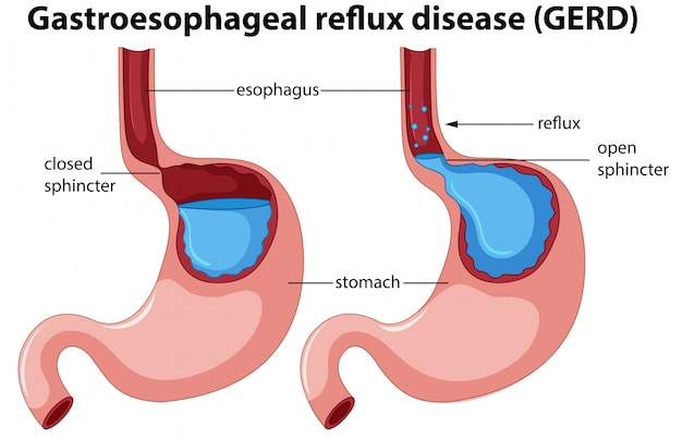 Vector gratuito anatomía de la enfermedad de reflujo gastroesofágico