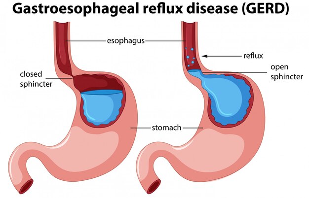 Anatomía de la enfermedad de reflujo gastroesofágico