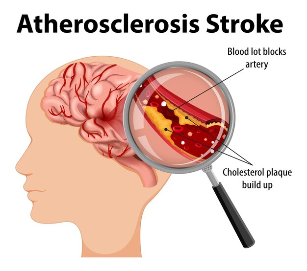 Anatomía humana con accidente cerebrovascular aterosclerosis