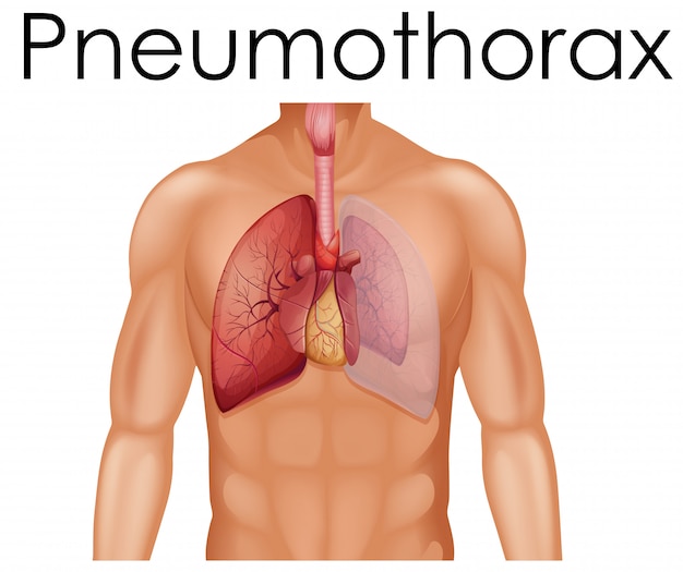 Una anatomía humana del neumotórax