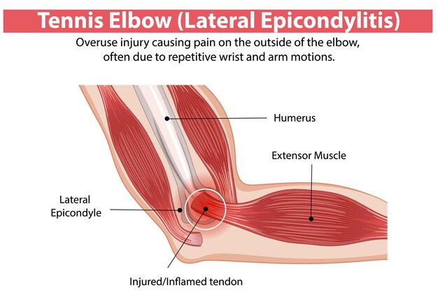 Anatomía y síntomas del codo de tenis