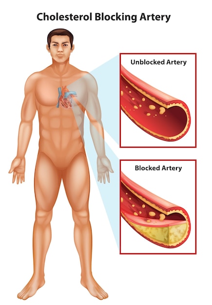 Vector gratuito arteriosclerosis