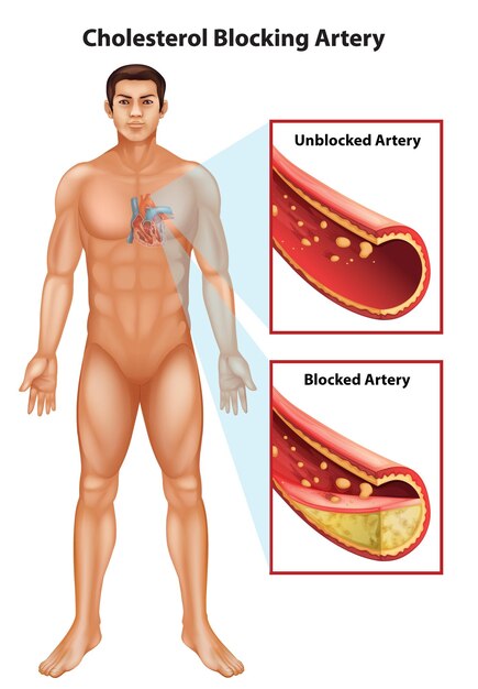 arteriosclerosis