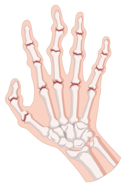 Vector gratuito la artritis reumatoide en la mano humana