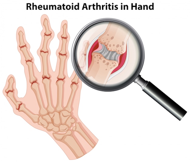 Artritis reumatoidea de la anatomía humana en la mano