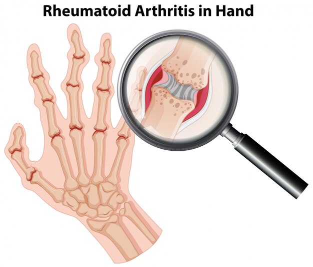Artritis reumatoidea de la anatomía humana en la mano