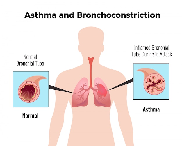 Ataque de asma gráfico educativo médico con representación de tubo bronquial normal e inflamado plano