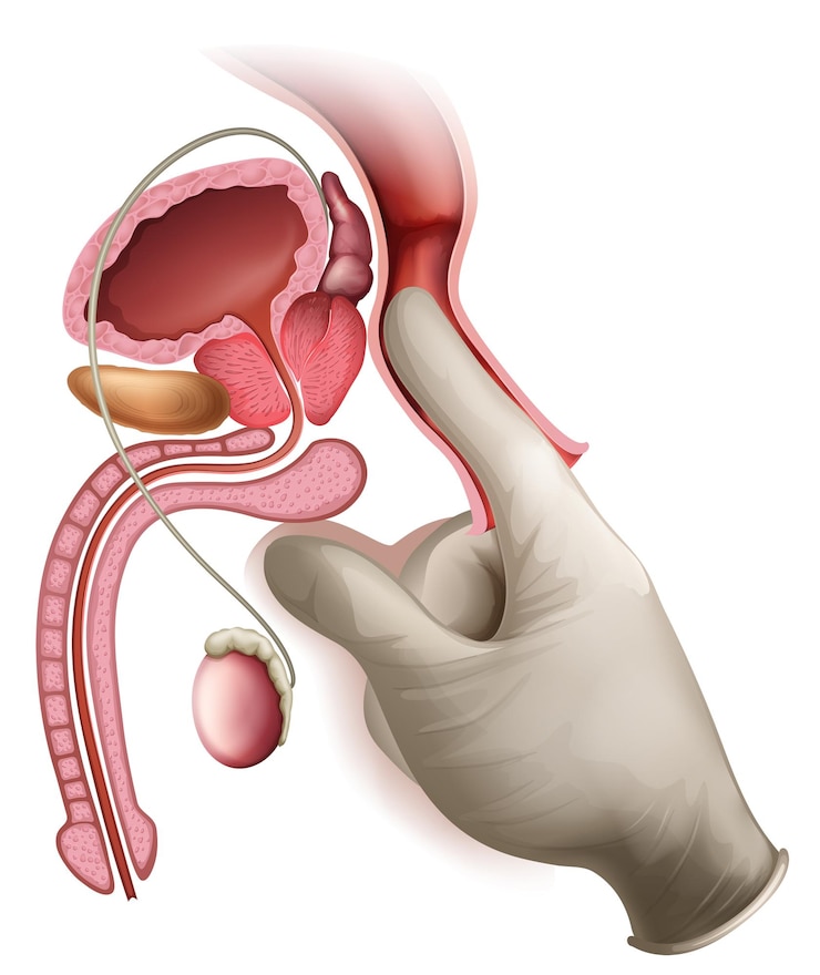 Vector gratuito un cáncer de próstata