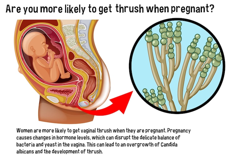 Vector gratuito candidiasis vaginal durante el embarazo infografía con explicación