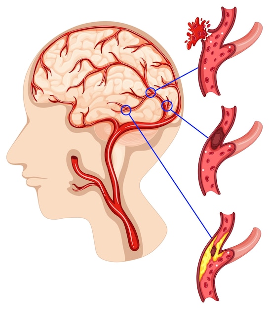 Vector gratuito caner en el cerebro humano