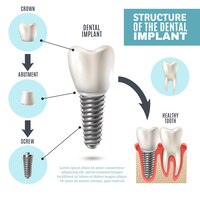 Vector gratuito cartel de infografía médica de la estructura del implante dental
