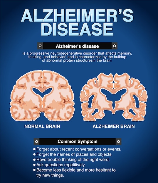 Cartel informativo de la enfermedad de Alzheimer
