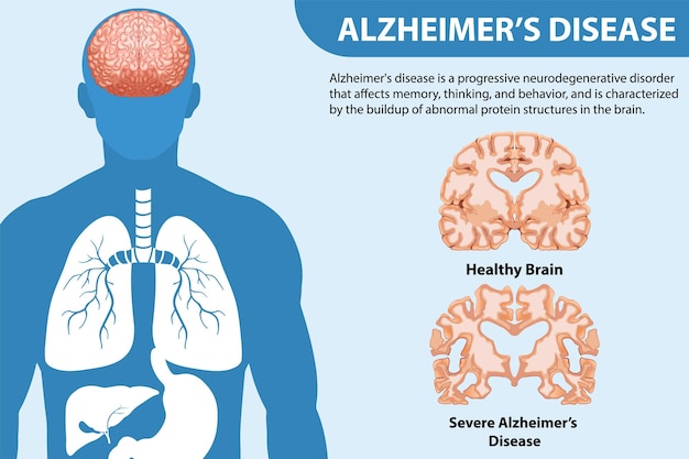 Cartel informativo de la enfermedad de Alzheimer