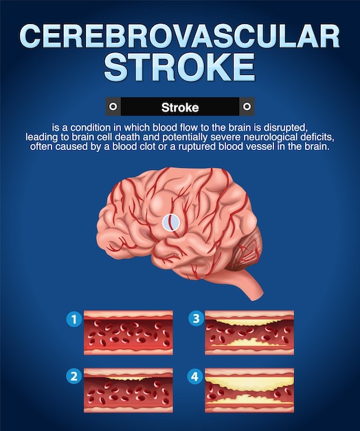 Vector gratuito cartel informativo del ictus cerebrovascular