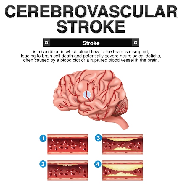 Vector gratuito cartel informativo del ictus cerebrovascular