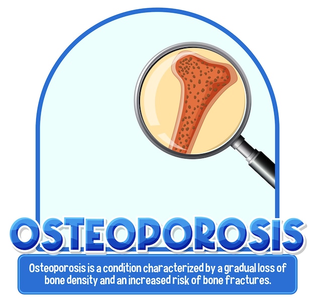 Cartel informativo de la osteoporosis ósea humana