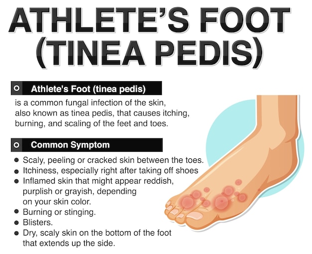Cartel informativo del pie de atleta