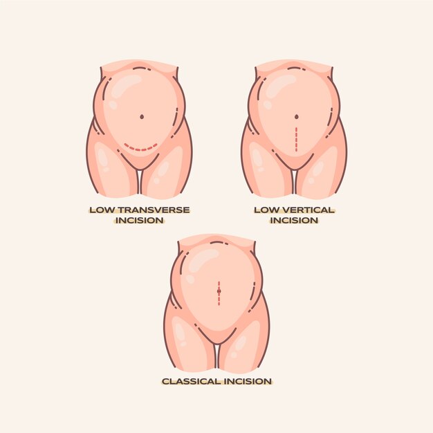 Cesárea de diseño plano dibujado a mano