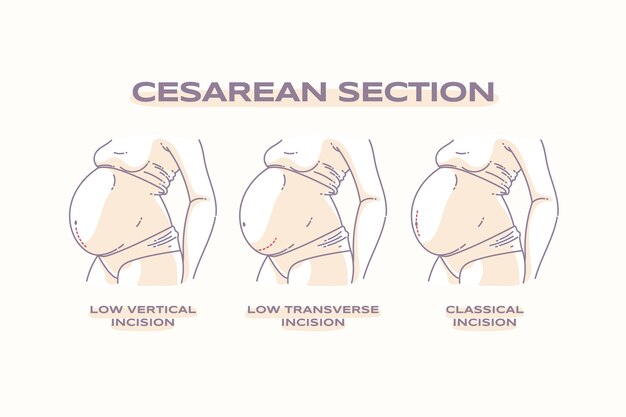 Cesárea de diseño plano dibujado a mano