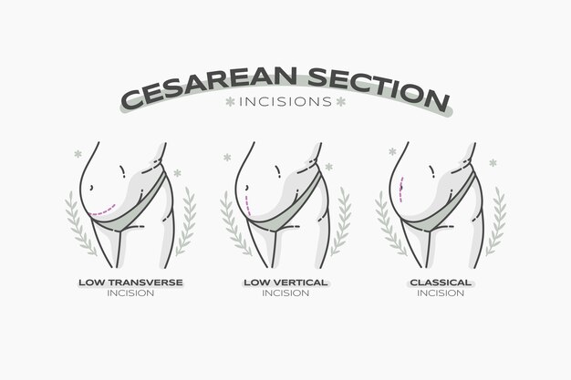 Cesárea de diseño plano dibujado a mano