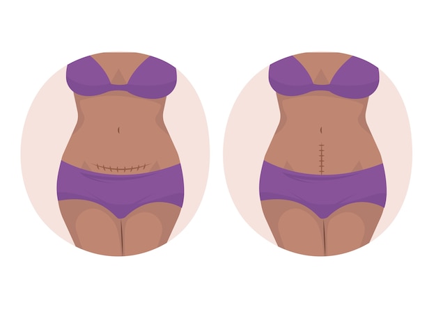 Cesárea de diseño plano dibujado a mano