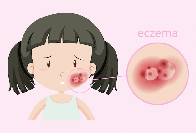 Vector gratuito chica con eczema en la cara