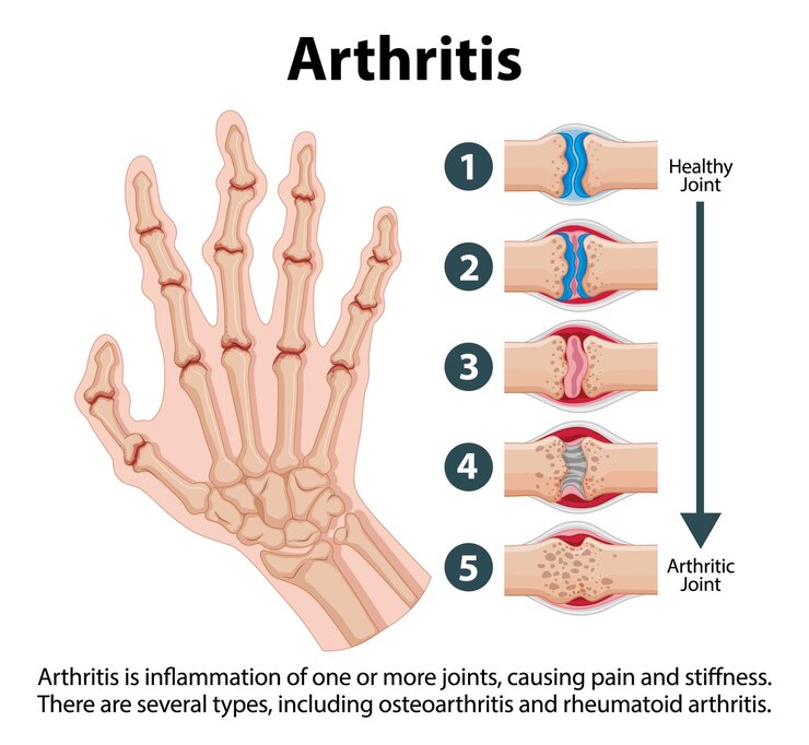 Vector gratuito ciencias educación anatomía humana y etapas de la artritis