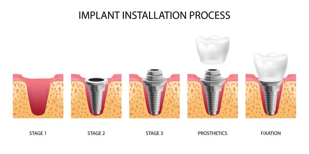 Cinco etapas de instalación de implantes dentales realistas aisladas