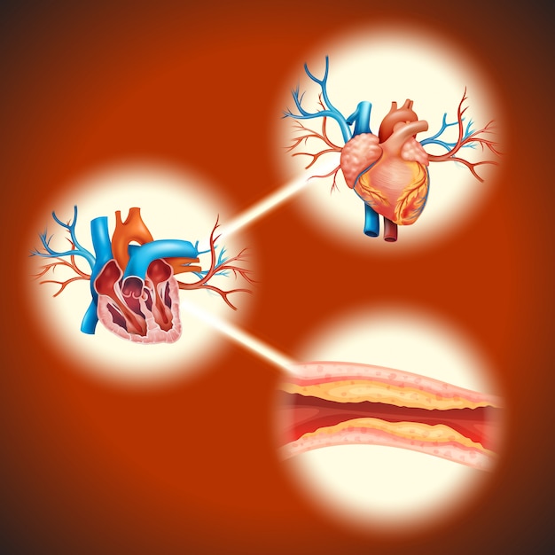 Colesteral en corazón humano