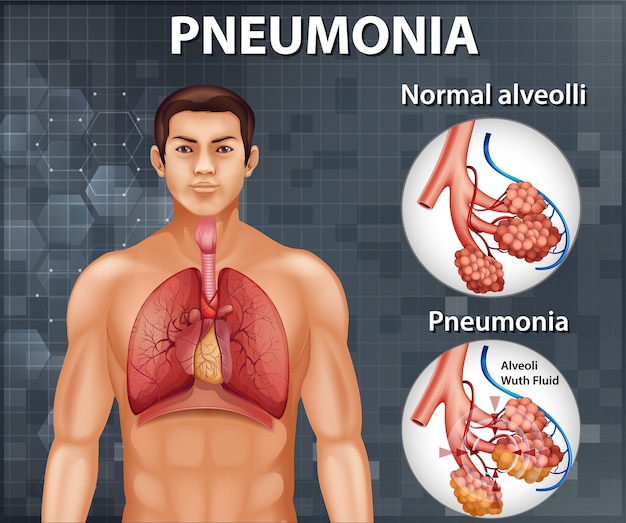 Vector gratuito comparación de alvéolos sanos y neumonía