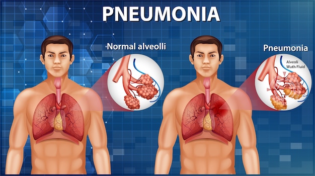 Vector gratuito comparación de alvéolos sanos y neumonía