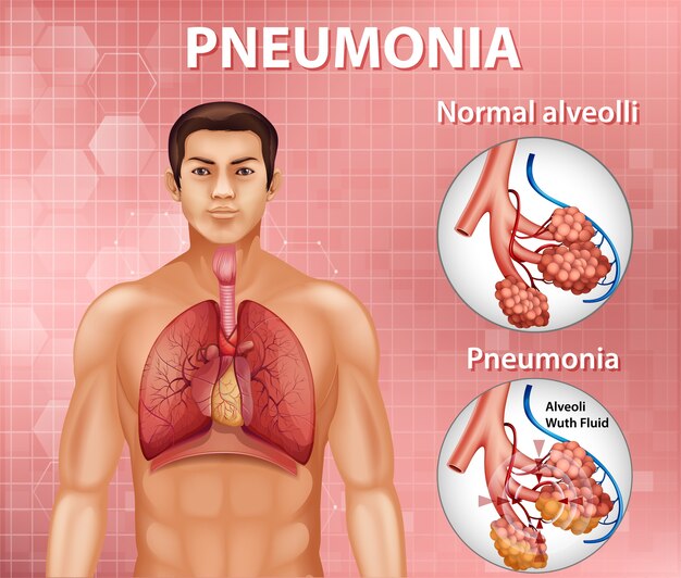 Comparación de alvéolos sanos y neumonía