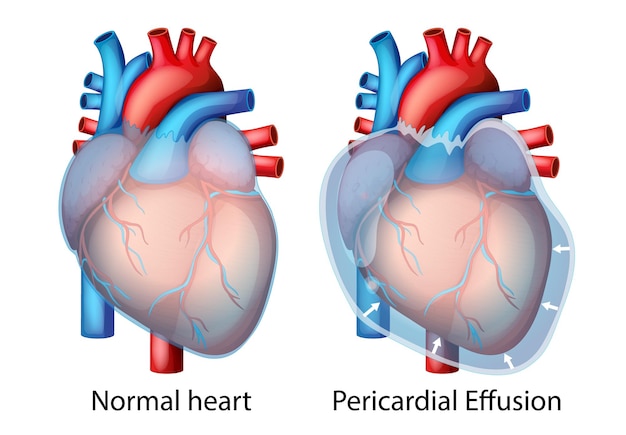 Comparación entre el corazón normal y el derrame pericárdico