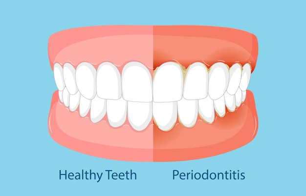 Comparación entre los dientes sanos y la periodontitis