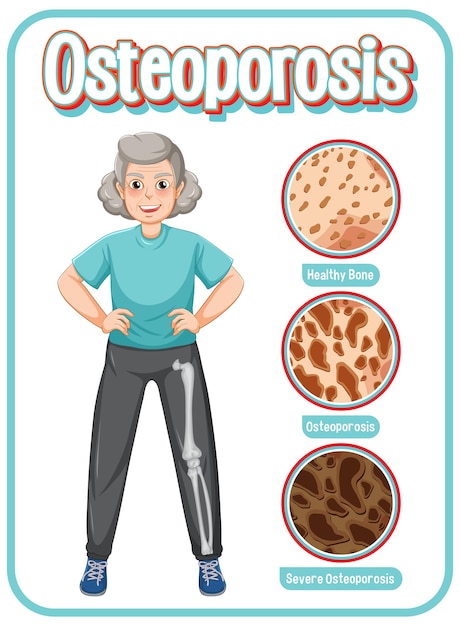 Vector gratuito comparación de hueso normal y hueso con osteoporosis en personas mayores