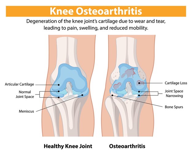 Comparación de la osteoartritis de la rodilla
