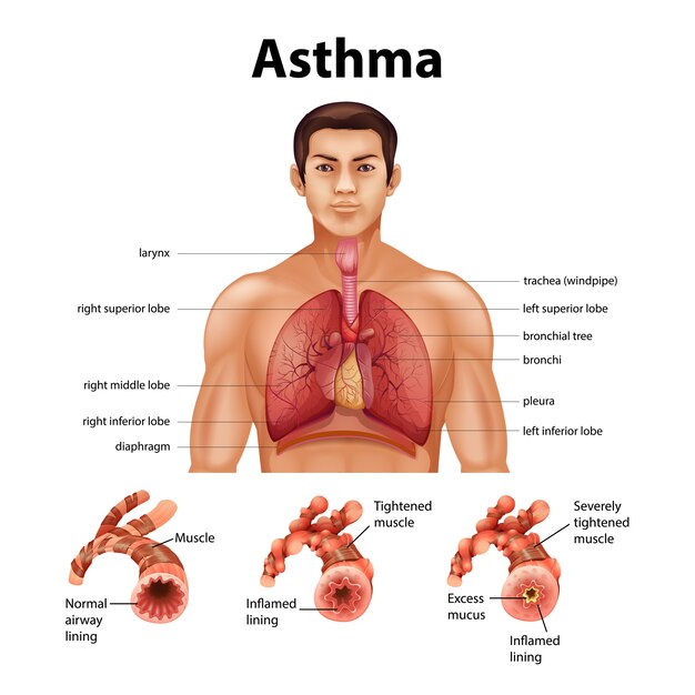 Comparación de pulmón sano y pulmón asmático