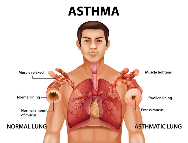 Comparación de pulmón sano y pulmón asmático