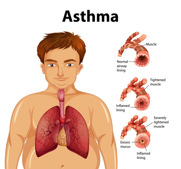 Vector gratuito comparación de pulmón sano y pulmón asmático